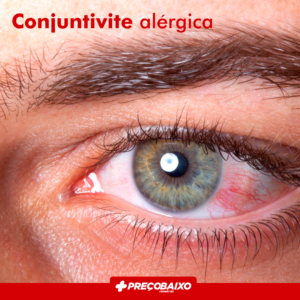 Read more about the article Conjuntivite Alérgica
